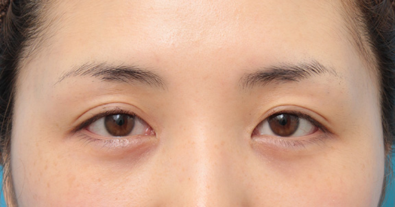 目頭切開,目頭切開で、平行型二重のまま目を内側に広げた症例写真,After（6ヶ月後）,ba_megashira053_b01.jpg