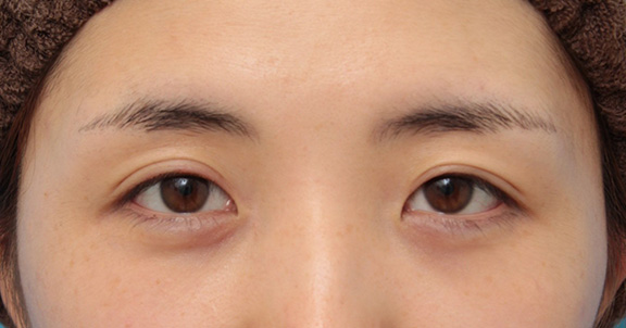 症例写真,目頭切開で、平行型二重のまま目を内側に広げた症例写真,Before,ba_megashira053_b01.jpg