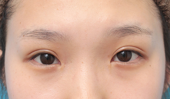 眼瞼下垂（がんけんかすい）,目頭切開、眼瞼下垂手術、タレ目形成を同時に行った症例写真,After（6ヶ月後）,ba_megashira054_b01.jpg