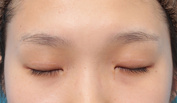 眼瞼下垂（がんけんかすい）,目頭切開、眼瞼下垂手術、タレ目形成を同時に行った症例写真,After（6ヶ月後の目を閉じた状態）,