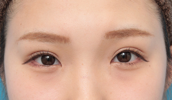 眼瞼下垂（がんけんかすい）,目頭切開、眼瞼下垂手術、タレ目形成を同時に行った症例写真,After（6ヶ月後メイクあり）,