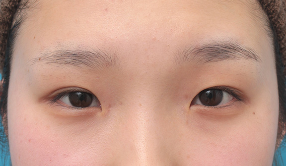 目頭切開,目頭切開、眼瞼下垂手術、タレ目形成を同時に行った症例写真,Before,ba_megashira054_b01.jpg