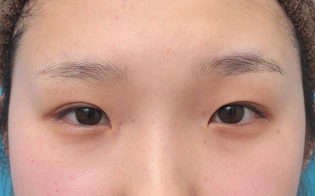 目頭切開,目頭切開、眼瞼下垂手術、タレ目形成を同時に行った症例写真,手術前,mainpic_megashira054a.jpg
