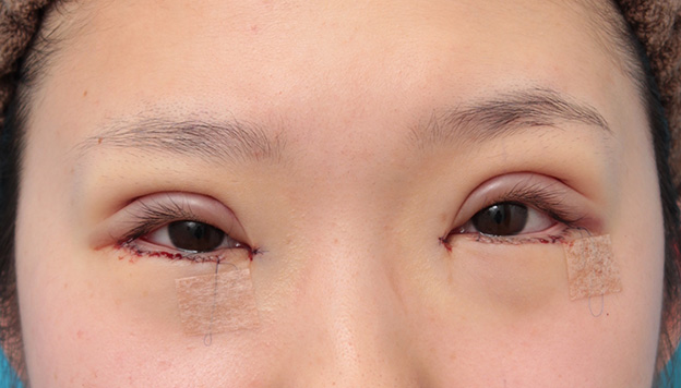 眼瞼下垂（がんけんかすい）,目頭切開、眼瞼下垂手術、タレ目形成を同時に行った症例写真,手術直後,目を開けた状態,mainpic_megashira054b.jpg