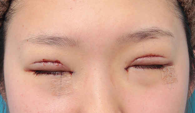 眼瞼下垂（がんけんかすい）,目頭切開、眼瞼下垂手術、タレ目形成を同時に行った症例写真,手術直後,目を閉じた状態,mainpic_megashira054c.jpg
