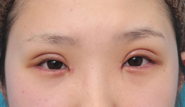 目頭切開,目頭切開、眼瞼下垂手術、タレ目形成を同時に行った症例写真,6日後,目を開けた状態,mainpic_megashira054d.jpg
