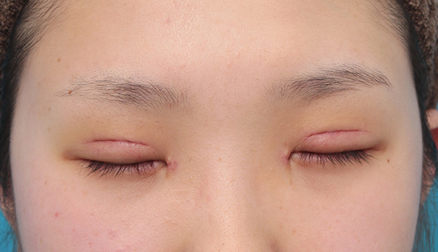 眼瞼下垂（がんけんかすい）,目頭切開、眼瞼下垂手術、タレ目形成を同時に行った症例写真,6日後,目を閉じた状態,mainpic_megashira054e.jpg