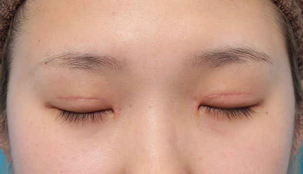 眼瞼下垂（がんけんかすい）,目頭切開、眼瞼下垂手術、タレ目形成を同時に行った症例写真,3週間後,目を閉じた状態,mainpic_megashira054g.jpg