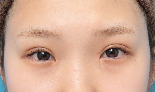 目頭切開,目頭切開、眼瞼下垂手術、タレ目形成を同時に行った症例写真,3ヶ月後,目を開けた状態,mainpic_megashira054h.jpg