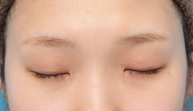 眼瞼下垂（がんけんかすい）,目頭切開、眼瞼下垂手術、タレ目形成を同時に行った症例写真,3ヶ月後,目を閉じた状態,mainpic_megashira054i.jpg