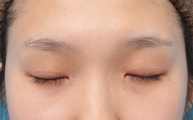 眼瞼下垂（がんけんかすい）,目頭切開、眼瞼下垂手術、タレ目形成を同時に行った症例写真,6ヶ月後,目を閉じた状態,mainpic_megashira054k.jpg