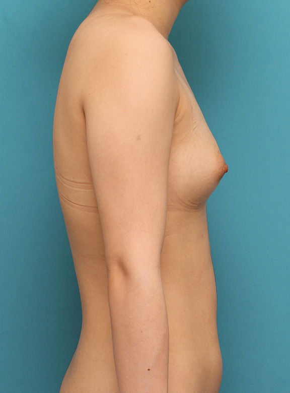 脂肪吸引,20代前半の痩せている女性の太ももとお尻から脂肪吸引し、バストに脂肪注入した症例写真,After（6ヶ月後）,ba_inject021_b03.jpg