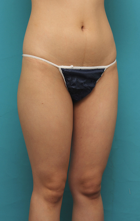 脂肪吸引,20代前半の痩せている女性の太ももとお尻から脂肪吸引し、バストに脂肪注入した症例写真,Before,ba_inject021_b05.jpg