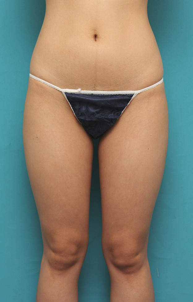 ピュアコンデンス脂肪注入豊胸,20代前半の痩せている女性の太ももとお尻から脂肪吸引し、バストに脂肪注入した症例写真,手術前,mainpic_inject021e.jpg