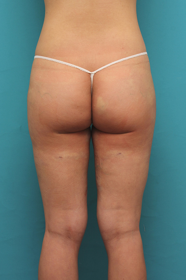 脂肪吸引,20代前半の痩せている女性の太ももとお尻から脂肪吸引し、バストに脂肪注入した症例写真,手術直後,mainpic_inject021j.jpg