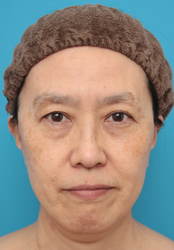 ミニフェイスリフト（頬のたるみ取り）,ミニフェイスリフト（頬のたるみ取り）で頬のたるみを改善させた60代女性の症例写真,After（6ヶ月後）,ba_minilift006_b01.jpg