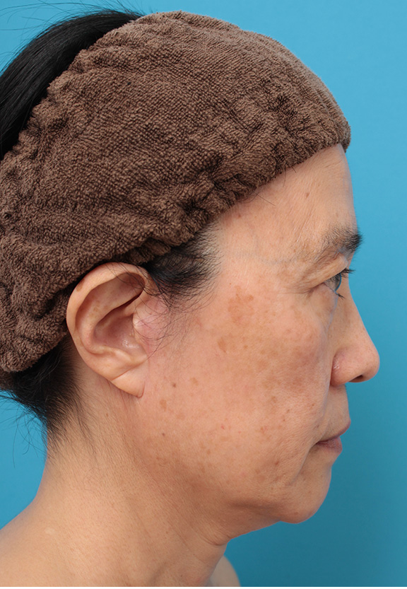 症例写真,ミニフェイスリフト（頬のたるみ取り）で頬のたるみを改善させた60代女性の症例写真,After（6ヶ月後）,ba_minilift006_b03.jpg