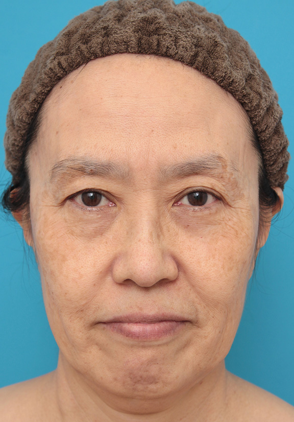 ミニフェイスリフト（頬のたるみ取り）で頬のたるみを改善させた60代女性の症例写真,Before,ba_minilift006_b01.jpg