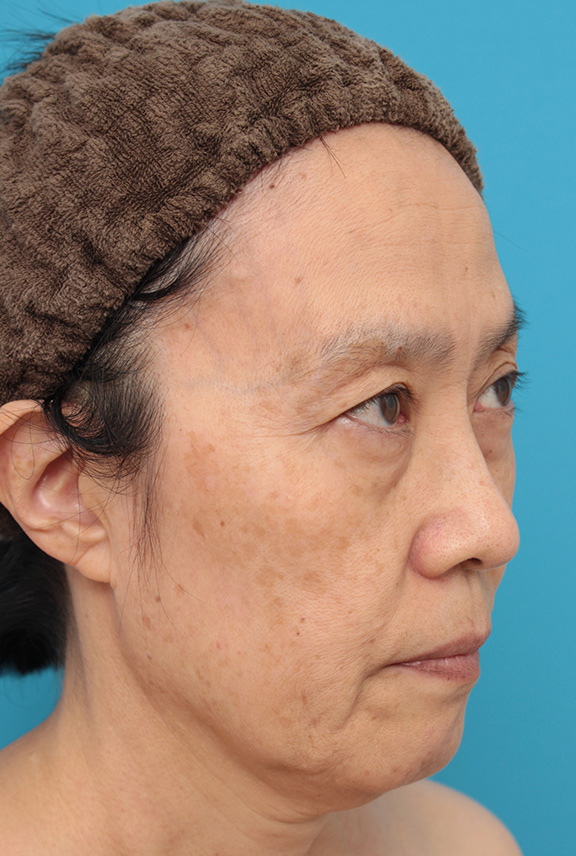 ミニフェイスリフト（頬のたるみ取り）,ミニフェイスリフト（頬のたるみ取り）で頬のたるみを改善させた60代女性の症例写真,Before,ba_minilift006_b02.jpg