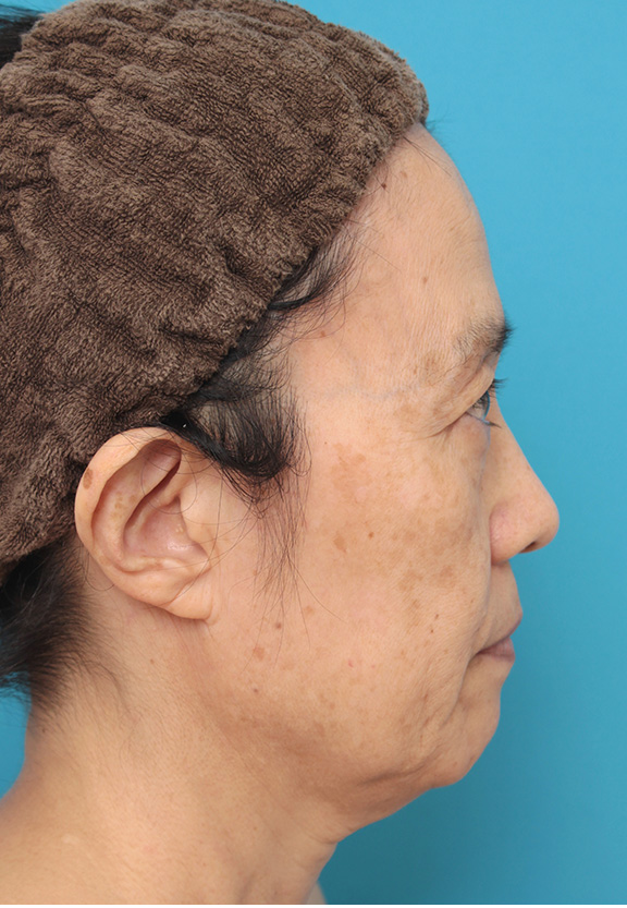 ミニフェイスリフト（頬のたるみ取り）,ミニフェイスリフト（頬のたるみ取り）で頬のたるみを改善させた60代女性の症例写真,Before,ba_minilift006_b03.jpg