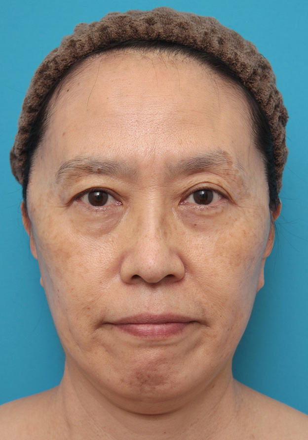 ミニフェイスリフト（頬のたるみ取り）,ミニフェイスリフト（頬のたるみ取り）で頬のたるみを改善させた60代女性の症例写真,1週間後,mainpic_minilift006c.jpg