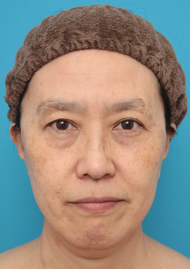 ミニフェイスリフト（頬のたるみ取り）,ミニフェイスリフト（頬のたるみ取り）で頬のたるみを改善させた60代女性の症例写真,6ヶ月後,mainpic_minilift006d.jpg