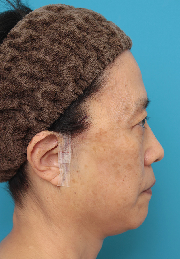 ミニフェイスリフト（頬のたるみ取り）,ミニフェイスリフト（頬のたるみ取り）で頬のたるみを改善させた60代女性の症例写真,手術直後,mainpic_minilift006f.jpg