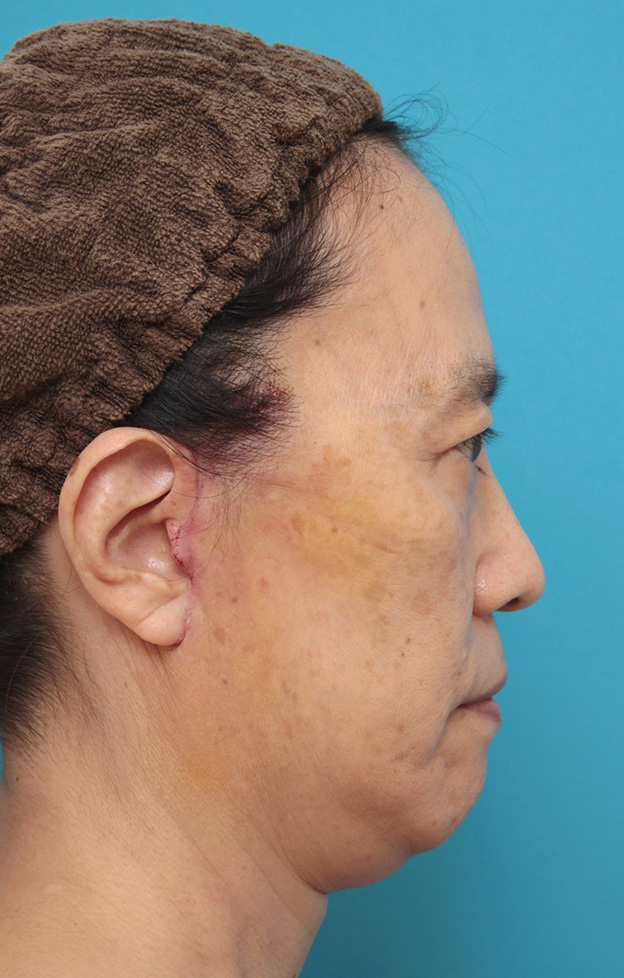 ミニフェイスリフト（頬のたるみ取り）,ミニフェイスリフト（頬のたるみ取り）で頬のたるみを改善させた60代女性の症例写真,1週間後,mainpic_minilift006g.jpg