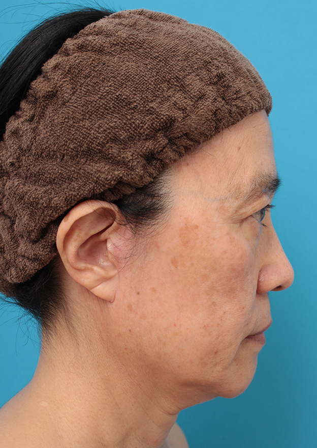 ミニフェイスリフト（頬のたるみ取り）,ミニフェイスリフト（頬のたるみ取り）で頬のたるみを改善させた60代女性の症例写真,6ヶ月後,mainpic_minilift006h.jpg