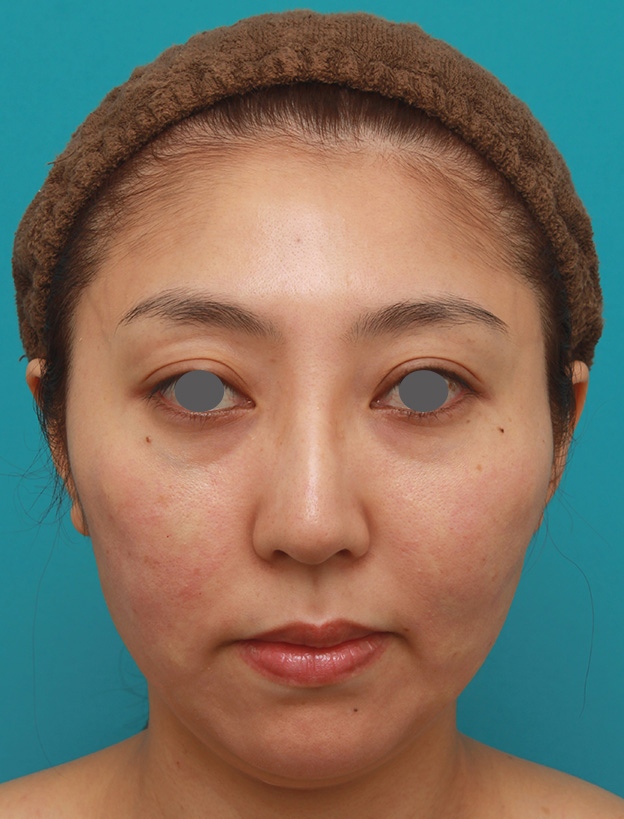 症例写真,小顔専用脂肪溶解注射メソシェイプフェイスで頬、フェイスライン、顎下の皮下脂肪を溶かした30代後半女性の症例写真,1回目注射直後,mainpic_meso_face005b.jpg