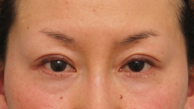 目尻切開,40代女性に目尻切開を行って目を外側に大きくした症例写真,手術前,mainpic_mejiri017a.jpg