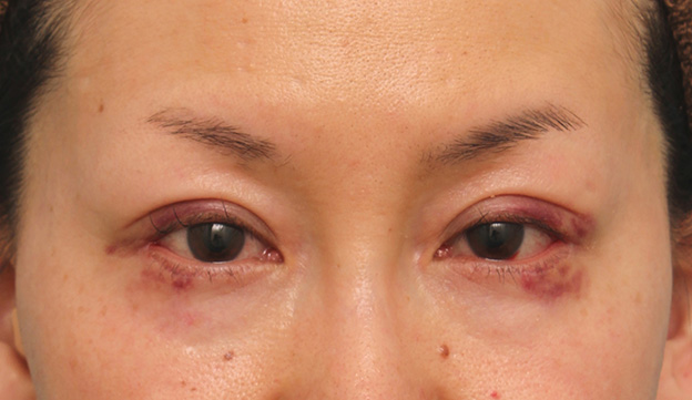 目尻切開,40代女性に目尻切開を行って目を外側に大きくした症例写真,6日後,mainpic_mejiri017c.jpg