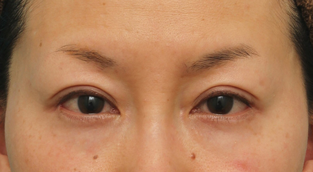 目尻切開,40代女性に目尻切開を行って目を外側に大きくした症例写真,7ヶ月後,mainpic_mejiri017e.jpg