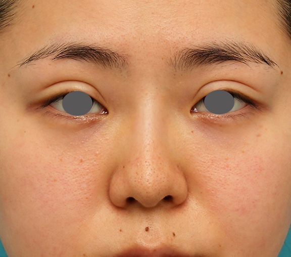 隆鼻注射（ヒアルロン酸注射）,横に広がらない流れない鼻の長期持続型ヒアルロン酸注射の症例写真,After（1年後）,ba_ryubi2030_a01.jpg