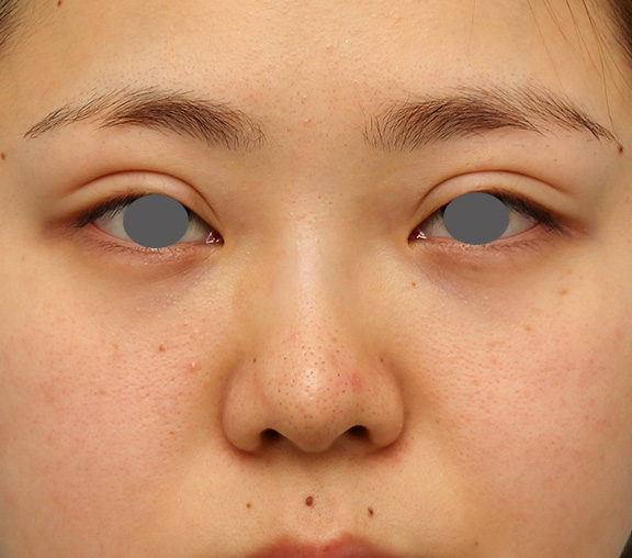 隆鼻注射（ヒアルロン酸注射）,横に広がらない流れない鼻の長期持続型ヒアルロン酸注射の症例写真,Before,ba_ryubi2030_b01.jpg