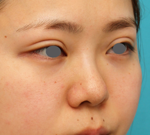 隆鼻注射（ヒアルロン酸注射）,横に広がらない流れない鼻の長期持続型ヒアルロン酸注射の症例写真,Before,ba_ryubi2030_b02.jpg