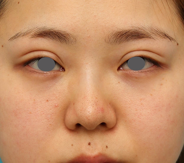 症例写真,横に広がらない流れない鼻の長期持続型ヒアルロン酸注射の症例写真,注射前,mainpic_ryubi2030a.jpg