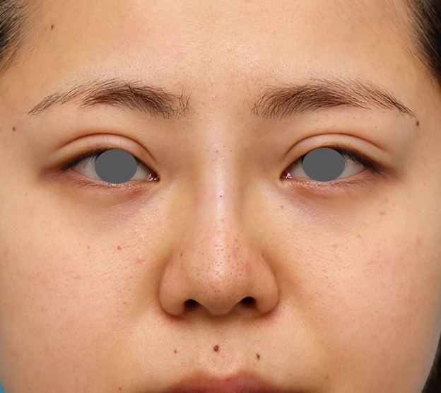 隆鼻注射（ヒアルロン酸注射）,横に広がらない流れない鼻の長期持続型ヒアルロン酸注射の症例写真,注射直後,mainpic_ryubi2030b.jpg