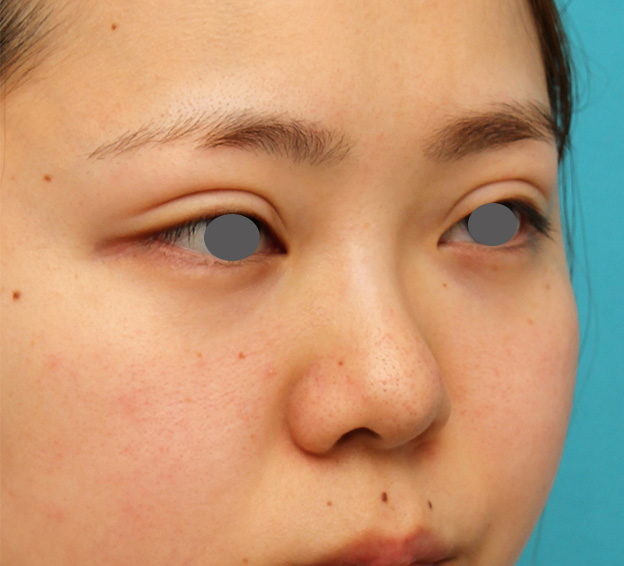 隆鼻注射（ヒアルロン酸注射）,横に広がらない流れない鼻の長期持続型ヒアルロン酸注射の症例写真,注射前,mainpic_ryubi2030e.jpg