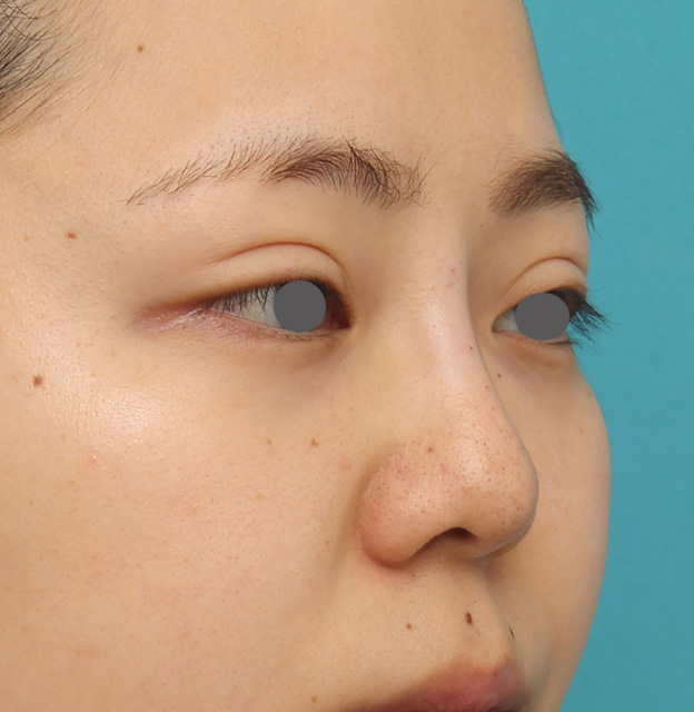 隆鼻注射（ヒアルロン酸注射）,横に広がらない流れない鼻の長期持続型ヒアルロン酸注射の症例写真,注射直後,mainpic_ryubi2030f.jpg