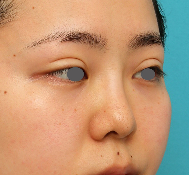 隆鼻注射（ヒアルロン酸注射）,横に広がらない流れない鼻の長期持続型ヒアルロン酸注射の症例写真,1年後,mainpic_ryubi2030h.jpg