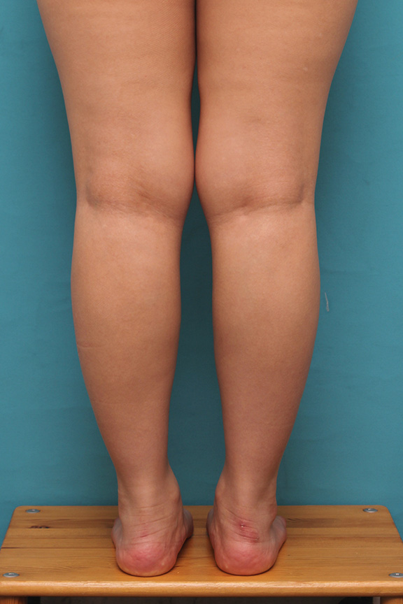 ボツリヌストキシン注射（ふくらはぎ・足やせ・美脚）,20代女性の発達したふくらはぎの筋肉をボツリヌストキシン注射で細くした症例写真,After（3ヶ月後）,ba_leg010_b01.jpg