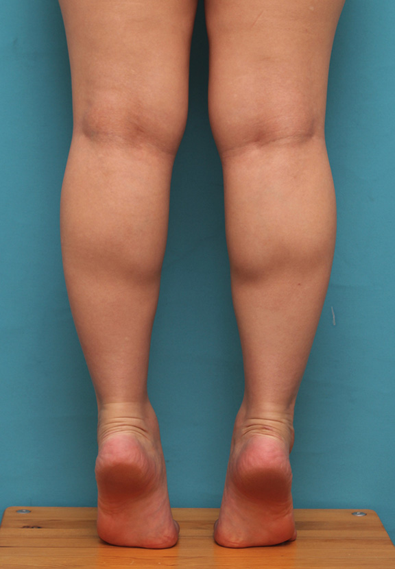 ボツリヌストキシン注射（ふくらはぎ・足やせ・美脚）,20代女性の発達したふくらはぎの筋肉をボツリヌストキシン注射で細くした症例写真,Before,ba_leg010_b02.jpg