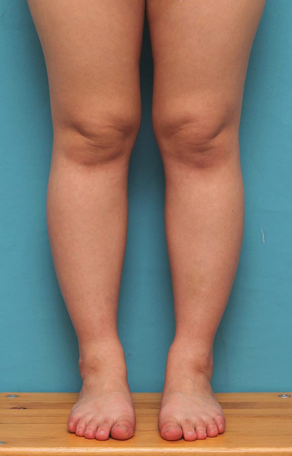ボツリヌストキシン注射（ふくらはぎ・足やせ・美脚）,20代女性の発達したふくらはぎの筋肉をボツリヌストキシン注射で細くした症例写真,Before,ba_leg010_b03.jpg