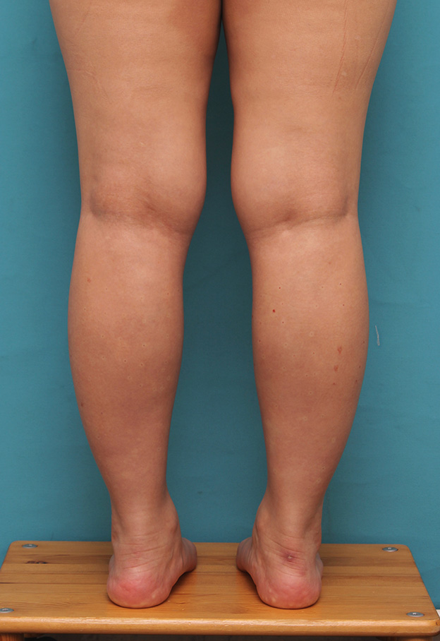 ボツリヌストキシン注射（ふくらはぎ・足やせ・美脚）,20代女性の発達したふくらはぎの筋肉をボツリヌストキシン注射で細くした症例写真,注射直後,mainpic_leg010b.jpg