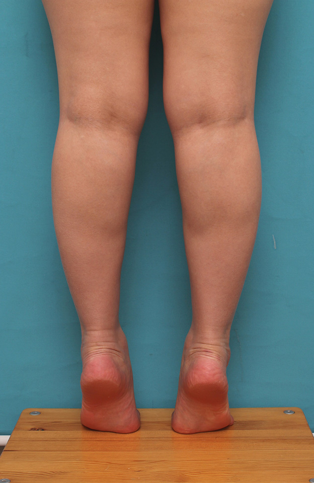 ボツリヌストキシン注射（ふくらはぎ・足やせ・美脚）,20代女性の発達したふくらはぎの筋肉をボツリヌストキシン注射で細くした症例写真,注射後1ヶ月,mainpic_leg010i.jpg