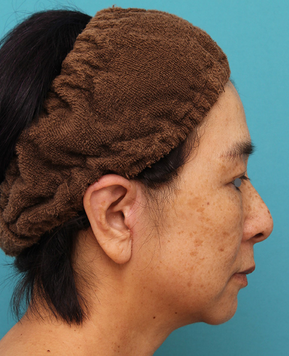ミディアムフェイスリフト,ミディアムフェイスリフトで頬のたるみをリフトアップさせた50代後半女性の症例写真,After（6ヶ月後）,ba_mediumlift008_b03.jpg