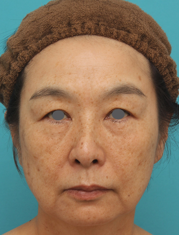 ミディアムフェイスリフト,ミディアムフェイスリフトで頬のたるみをリフトアップさせた50代後半女性の症例写真,Before,ba_mediumlift008_b01.jpg