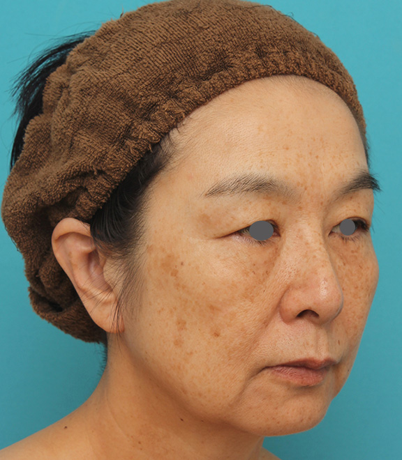 ミディアムフェイスリフト,ミディアムフェイスリフトで頬のたるみをリフトアップさせた50代後半女性の症例写真,Before,ba_mediumlift008_b02.jpg