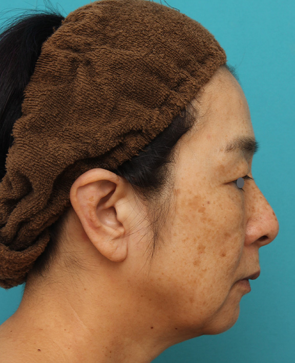 ミディアムフェイスリフト,ミディアムフェイスリフトで頬のたるみをリフトアップさせた50代後半女性の症例写真,Before,ba_mediumlift008_b03.jpg